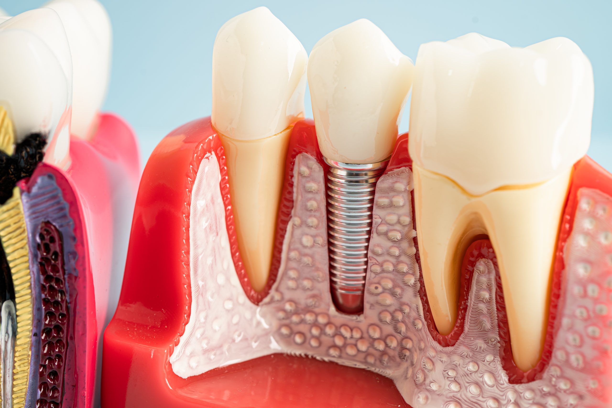 Dental implant, artificial tooth roots into jaw, root canal of d
