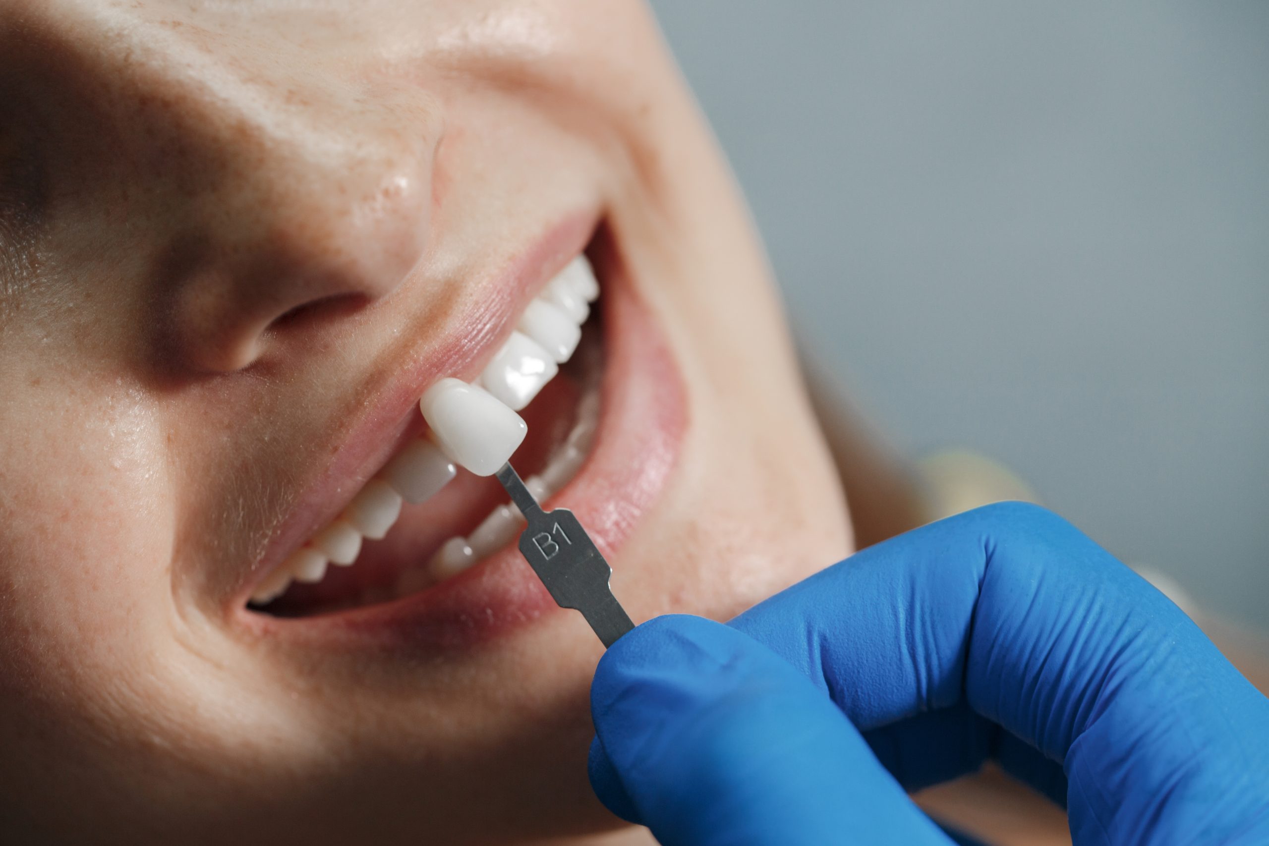 Implantes dentales F2